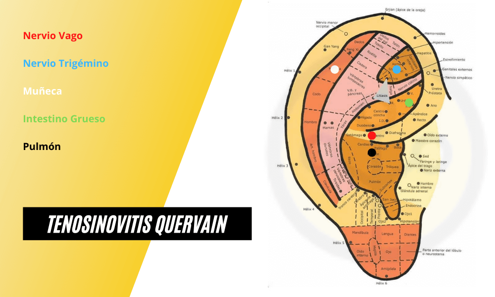 Auriculoterapia Tenosinotivis Quervain.png